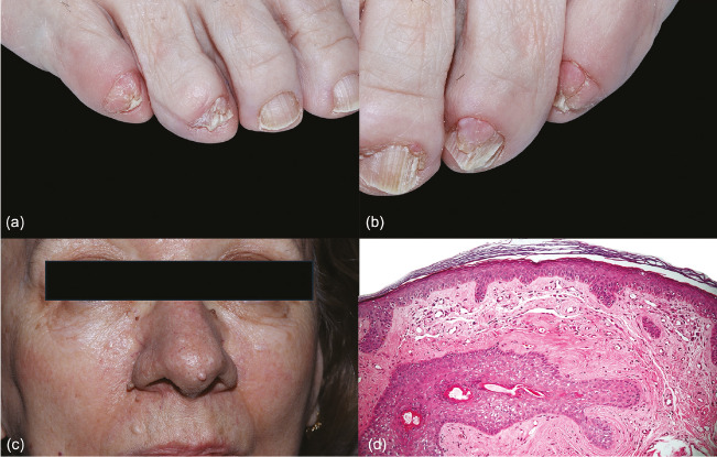 Onychopapilloma and Ungual Fibroma Revealing Late-Diagnosed Tuberous Sclerosis