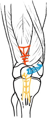 4in1 Procedure in Treating Congenital Dislocation of Patella in Children.