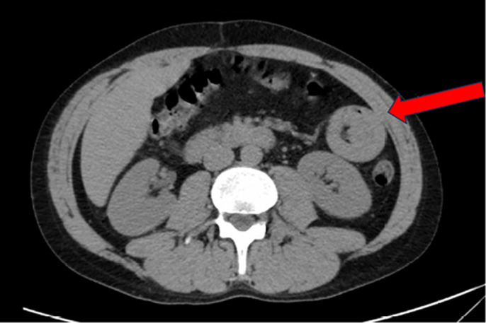 Robotic Bowel Resection for Adult Intussusception with History of Marijuana Use.
