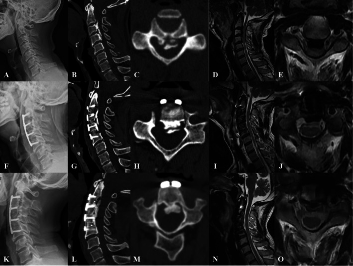 AUSS Assisted ACAF Technique in the Treatment of Ossification of the Posterior Longitudinal Ligament Extending to the C2 Segment.