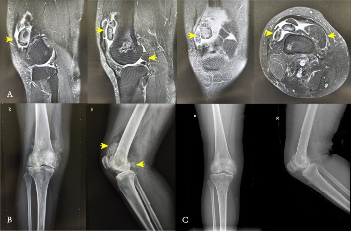 Efficacy Analysis of Arthroscopic Treatment of Synovial Chondromatosis of the Knee: A Retrospective Study of More Than Five Years.