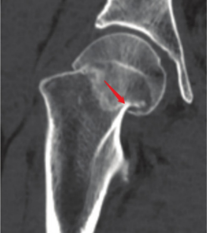 A Retrospective Study on the Relationship Between Calcar Femorale Injury and Postoperative Complications of Femoral Neck Fracture in Young and Middle-Aged Patients Treated With Three Cannulated Screws.