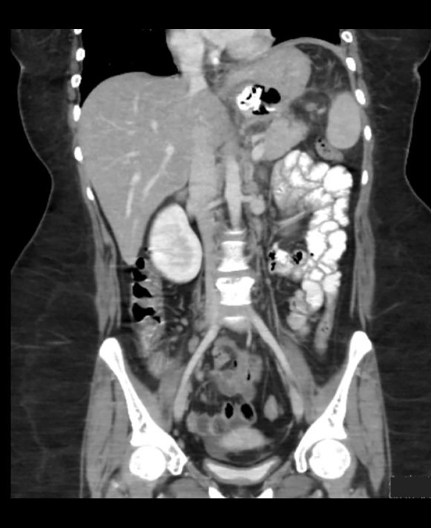 Innovative Use of Atrial Septal Defect Occluders for Gastric Leak Management After Sleeve Gastrectomy: A Case Report.
