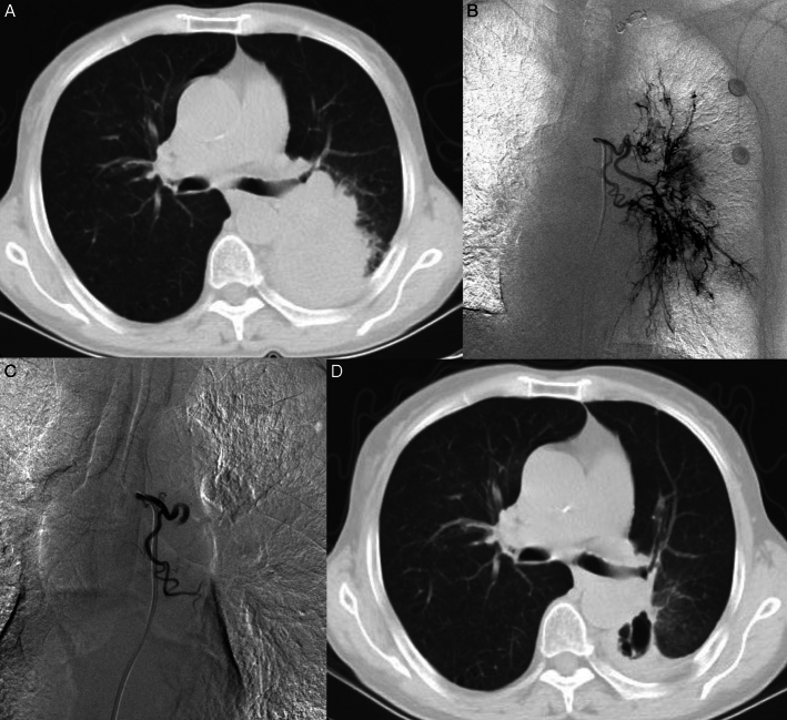 Bronchial Arterial Chemoembolization With Drug-eluting Beads Versus With Gelfoam Particles for Advanced Nonsmall-cell Lung Cancer.