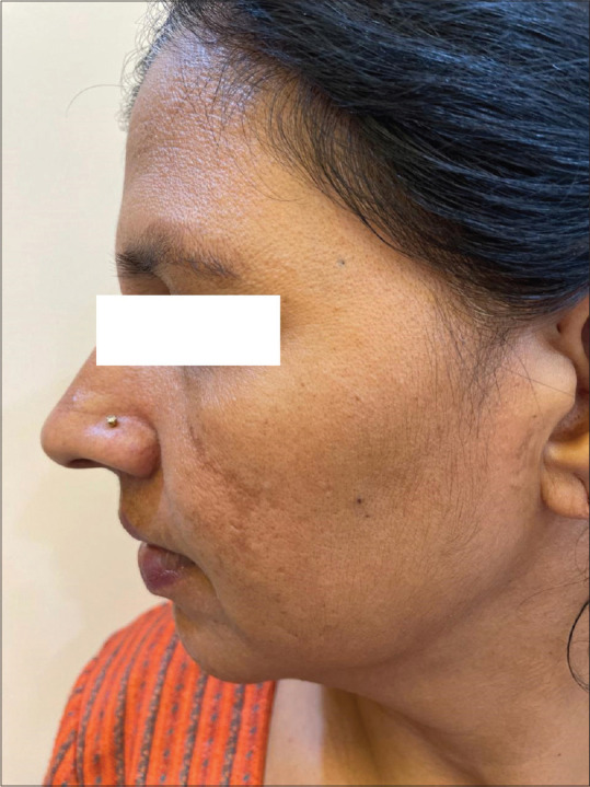 Thiamidol in Melasma in Patients of Skin of Color: A Preliminary Report of Efficacy and Safety.