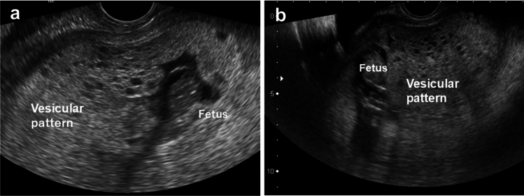 Outcomes of cases with complete hydatidiform mole coexisting with a fetus: a single-center study.