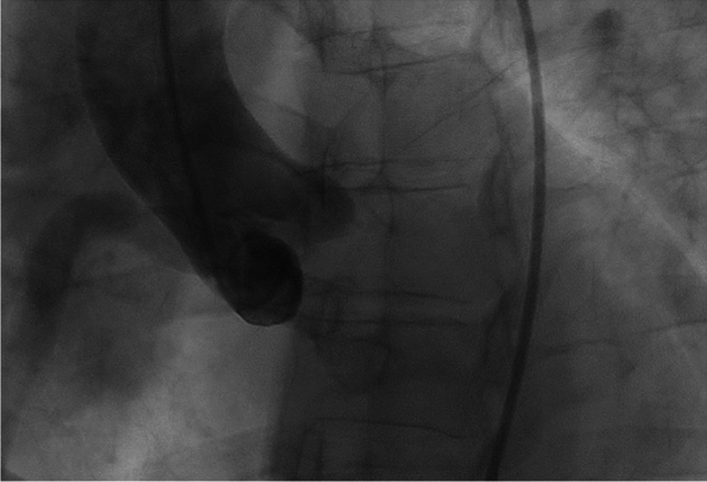 A 39-year-old women with newly diagnosed ALCAPA syndrome during pregnancy.