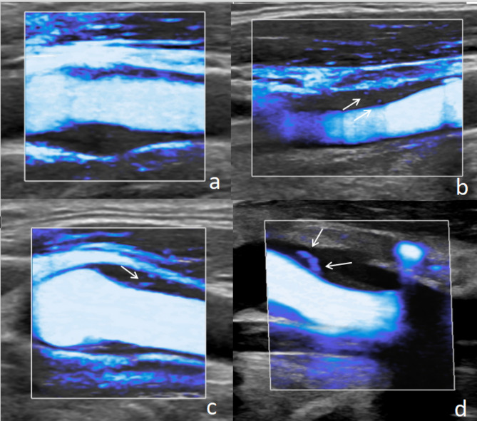 Current status and advances in ultrasound evaluation of neovascularization within carotid artery plaques: a systematic review.