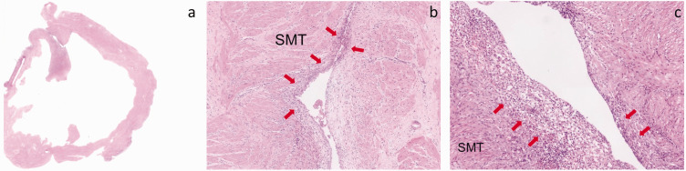 Accessory cavitated uterine malformation in a perimenopausal woman: Case report and literature review.