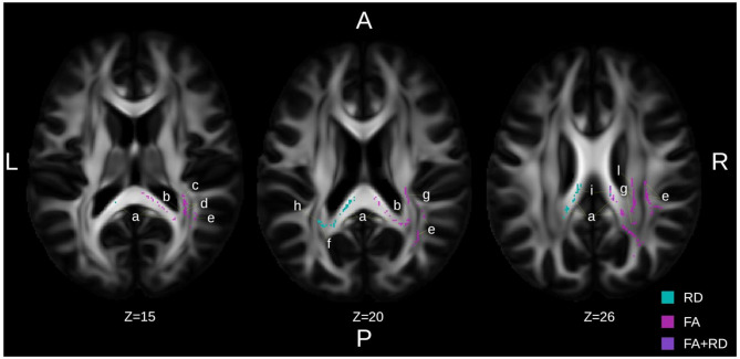 Structural brain improvements following individually tailored serious exergame-based training in mild neurocognitive disorders: exploratory randomized controlled trial.