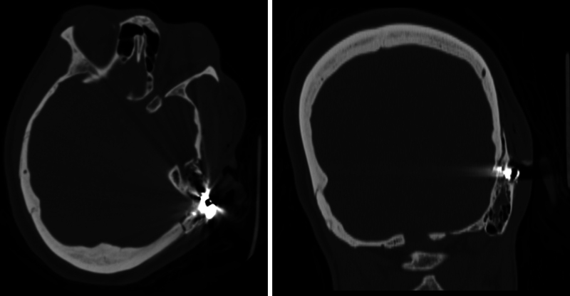 Upfront use of temporal myofascial flap for repair of traumatic injury and prevention of CSF leaks: illustrative cases.