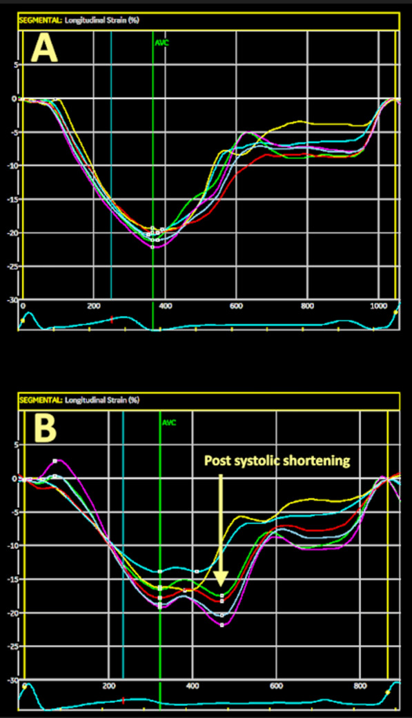 Pathological post-systolic shortening as a prognostic marker for major cardiovascular events in patients with type 2 diabetes.