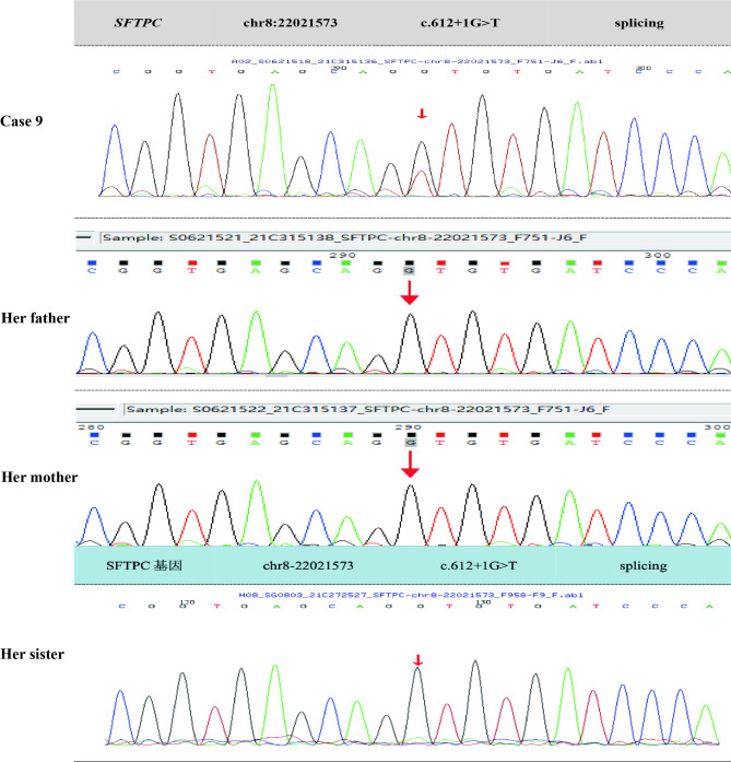 Clinical characteristics of SFTPC gene mutations in children: a single-center experience.