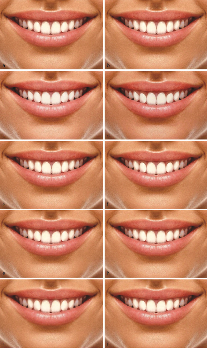 Effects of Shape and Position of Gingival Margin of Maxillary Anterior Teeth on Perception of Smile Aesthetics by Periodontists, Restorative Dentists, General Dentists, and Non-professionals.