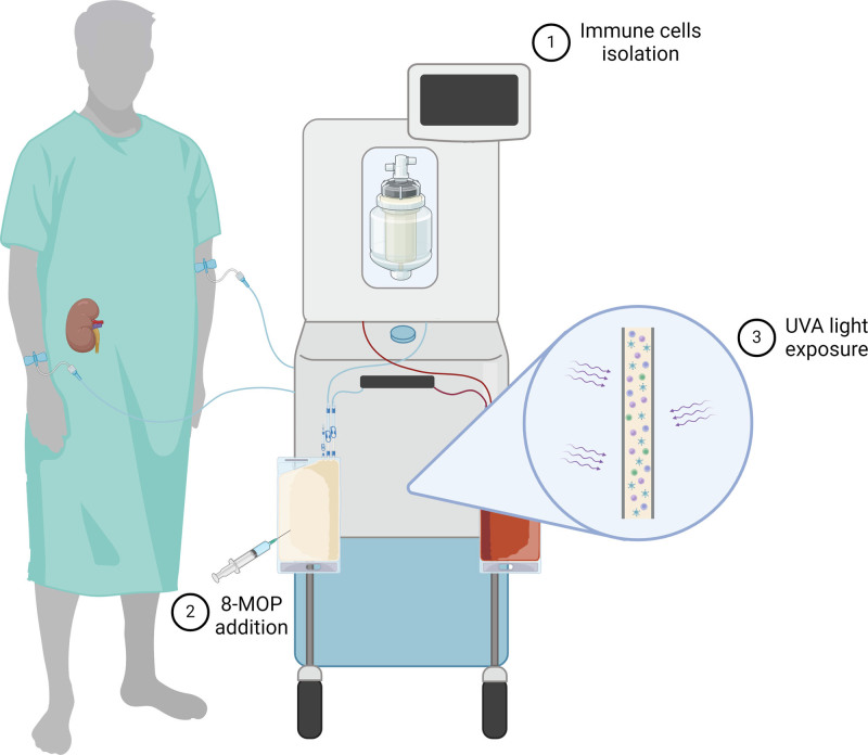 Exploring the Role of Extracorporeal Photopheresis in Kidney Transplant Management.
