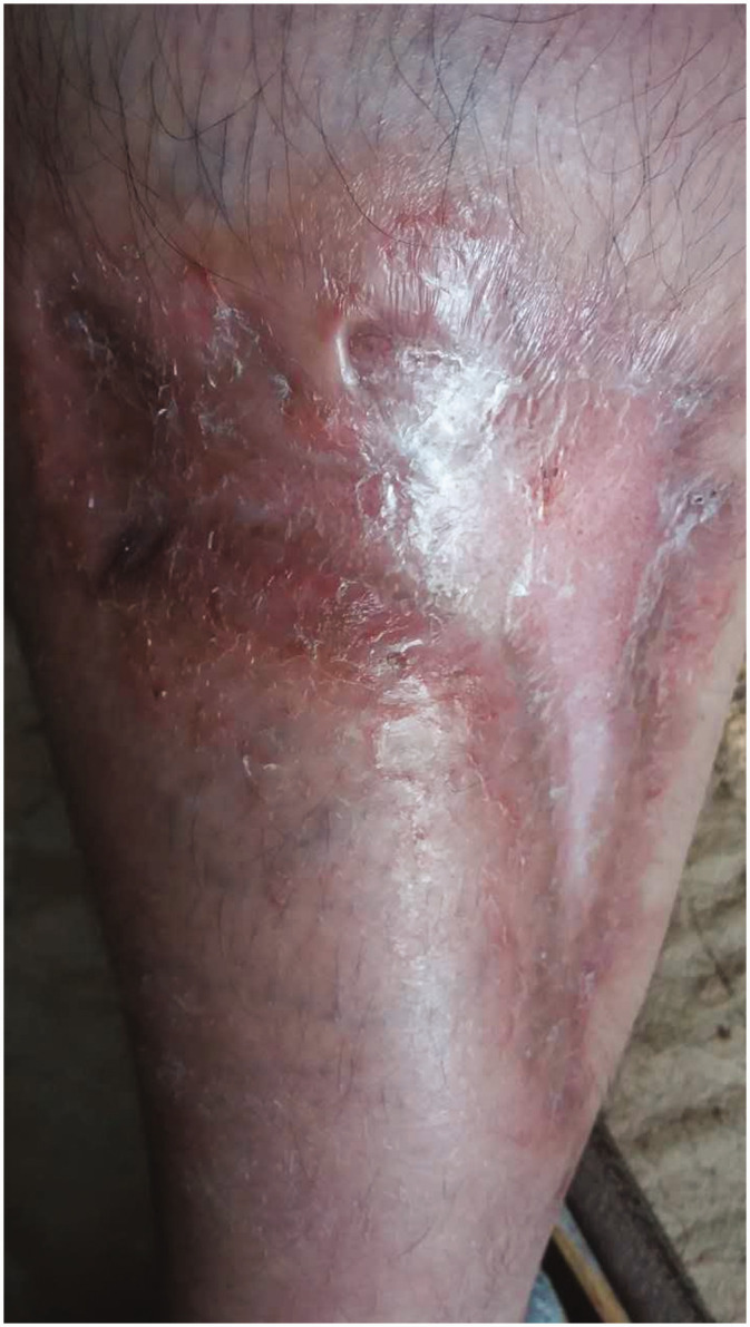 Recurrent single-organ cutaneous small-vessel vasculitis with streptococcal infection in a pediatric patient: A case report.