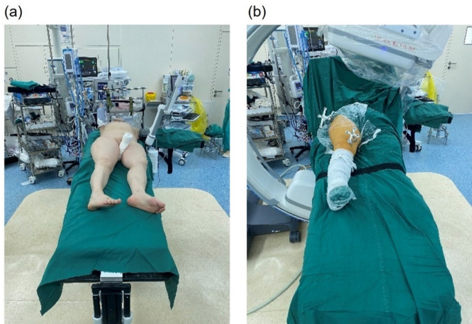 Robot-assisted closed reduction of femoral shaft fractures: a prospective controlled study.