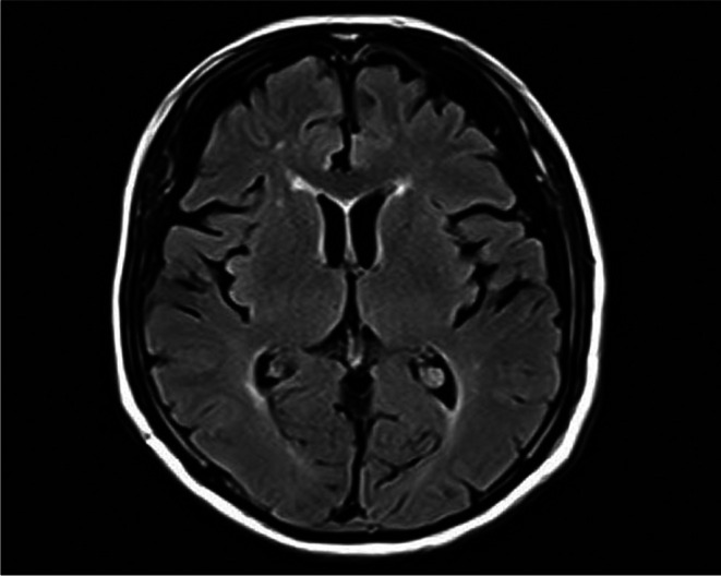 Successful Early Treatment of Anti-N-Methyl-d-Aspartate Receptor Encephalitis Associated With Small Cell Lung Cancer in an Elderly Male Patient: A Case Report.