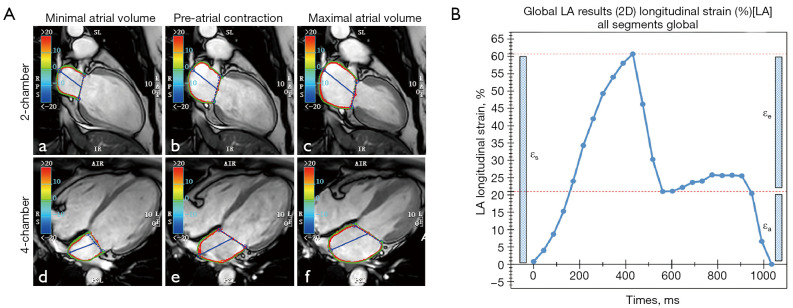 Prognostic value of left atrial strain analysis using cardiac magnetic resonance feature tracking technology for patients with acute myocarditis.