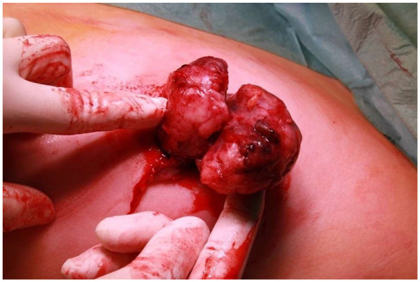 Juvenile Fibroadenoma Detected at 2 Years and Rapid Growth at Thelarche: Case Report and Literature Review.