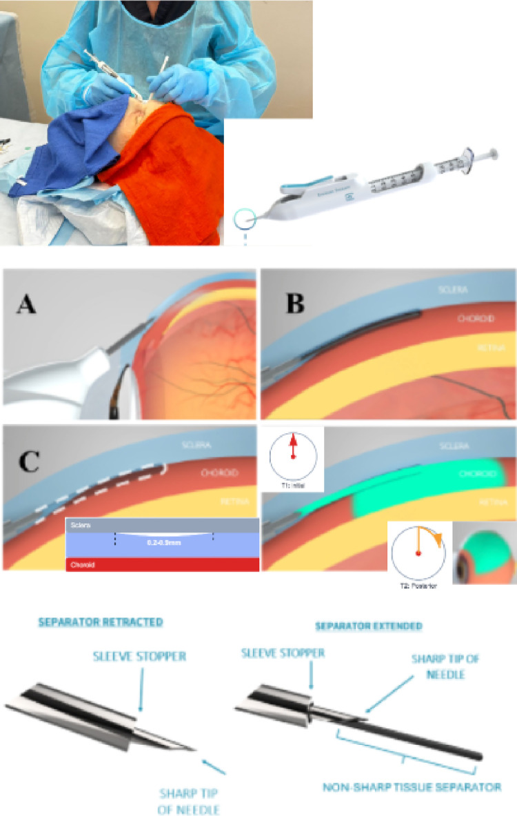 Near-Real Surgical Specimens (NRSS): A Novel Platform for Standardized Assessment of Suprachoroidal Drug Delivery.
