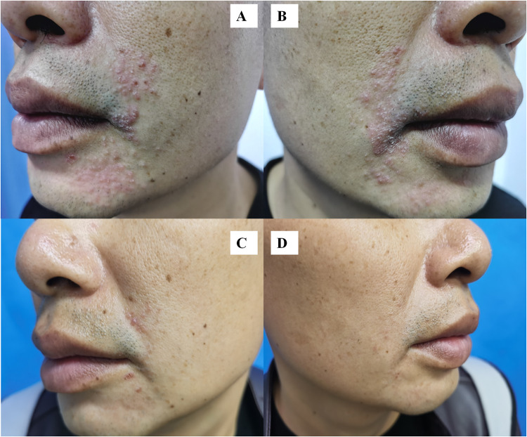 <i>Naganishia albidus</i> Causing Perioral Cutaneous Infection: A Rare Case Easily Misdiagnosed.
