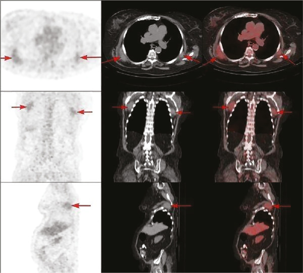 Incidental identification of elastofibroma dorsi in oncologic PET/CT imaging: a retrospective single-center analysis.