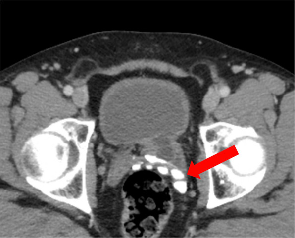 Combined robot-assisted surgery of upper and lower genitourinary tract with excellent early functional and oncological outcome - a case report of a concomitant nerve-sparing radical prostatectomy, diverticulectomy and ureterectomy.