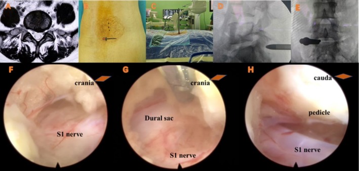 Radiographic Anatomy and Clinical Value of the Modified Corner Approach in Interlaminar Endoscopic Lumbar Discectomy.