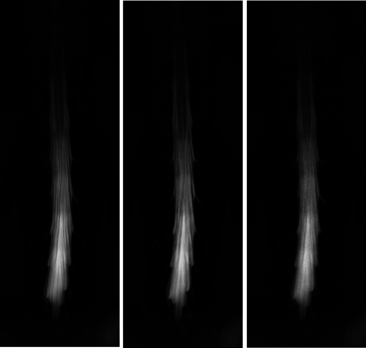 Super-resolution deep learning reconstruction to evaluate lumbar spinal stenosis status on magnetic resonance myelography.