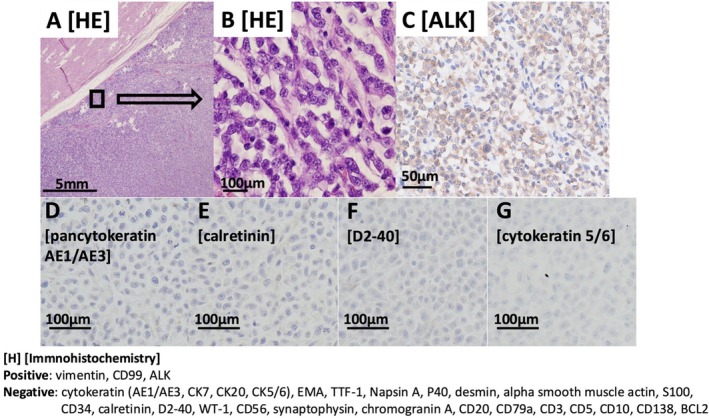 Anaplastic Lymphoma Kinase-Rearranged Chest Wall-Undifferentiated Small Round Cell Sarcoma With Massive Pleural Effusion and Rapid Progression: A Case With Autopsy Report.