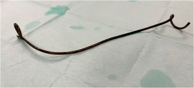 Nineteen-year forgotten ureteral stent removed under local anaesthetic from a transplanted kidney.