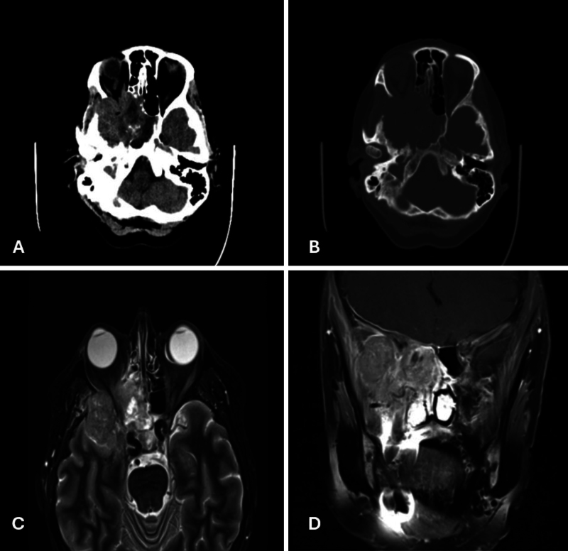 Brain tumors linked to Chernobyl radiation exposure: a case study and historical perspective. Illustrative cases.