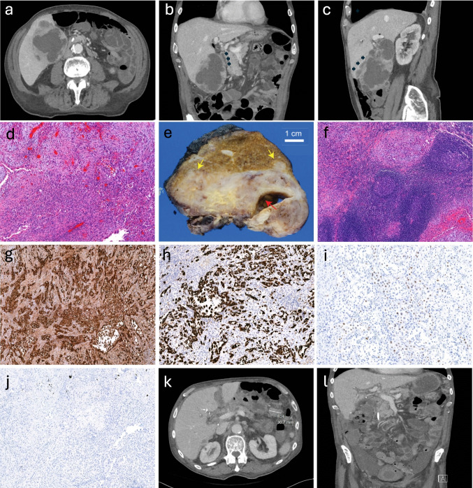 Gallbladder Squamous Cell Carcinoma with Diffuse β-hCG Expression: A Case Report and Review of the Literature.
