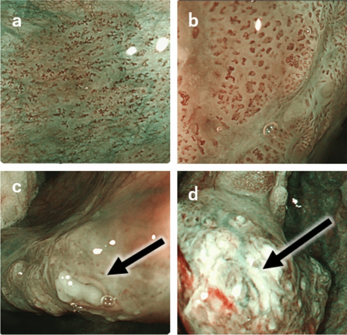Treatment strategies and prognosis of superficial laryngo-pharyngeal cancer: a literature review.