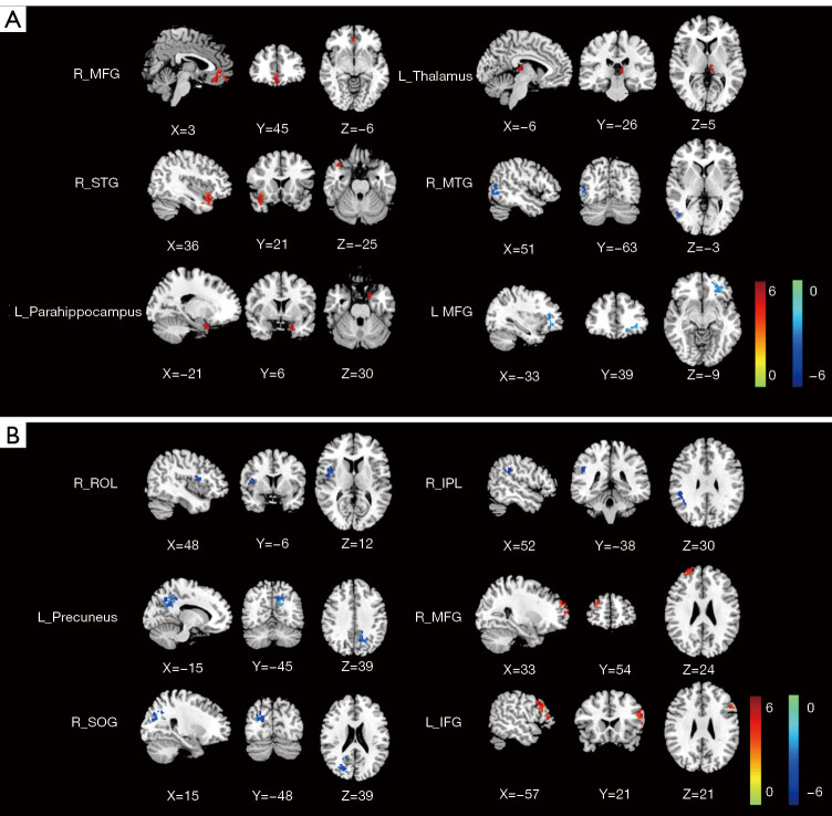 Disrupted neurovascular coupling in patients with lung cancer after chemotherapy.