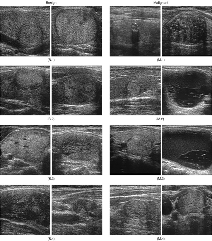 Combining curriculum learning and weakly supervised attention for enhanced thyroid nodule assessment in ultrasound imaging.