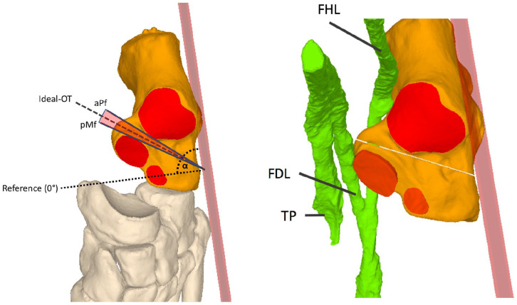 The Importance of the Entry Point and Osteotomy Direction in Calcaneal Lengthening Osteotomy.