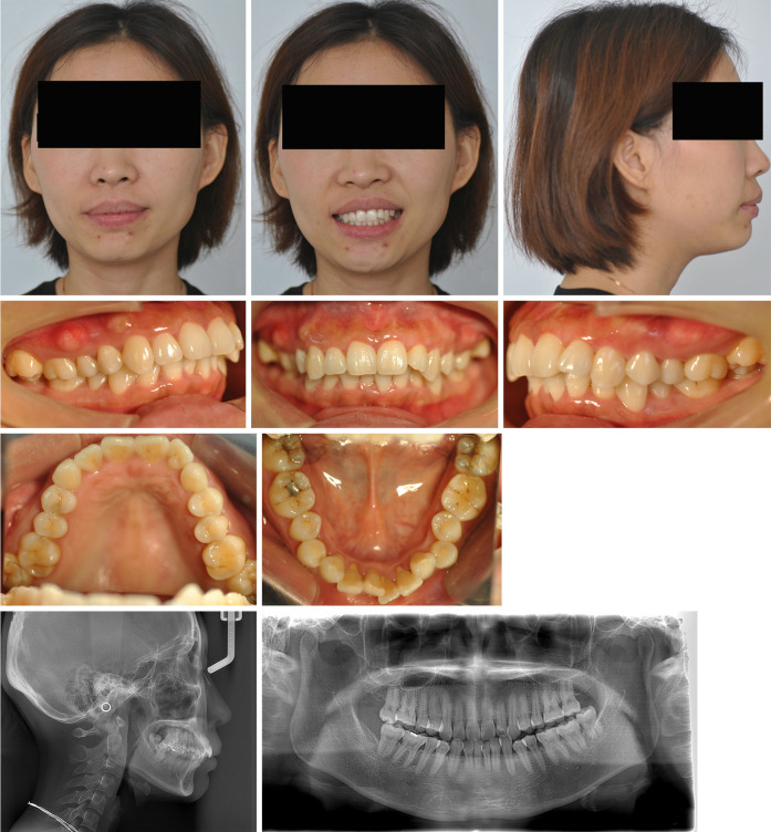 Management of bilateral molar deep overbite with buccal crossbite using bracket-free clear aligners: a case description.