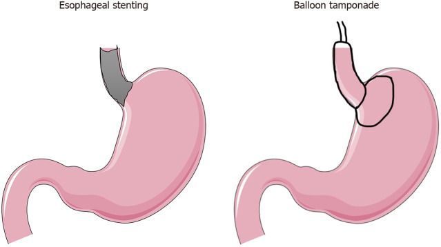 Decline of the Sengstaken-Blakemore tube: A review of shifting practices in gastrointestinal hemorrhage management.