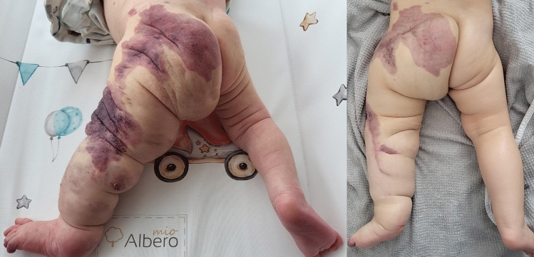 Effective Sirolimus Use in Prenatal and Postnatal Management of Symptomatic Extensive Congenital Capillary-Lymphatic-Venous Malformations (CLVMs): A Report of Two Cases.
