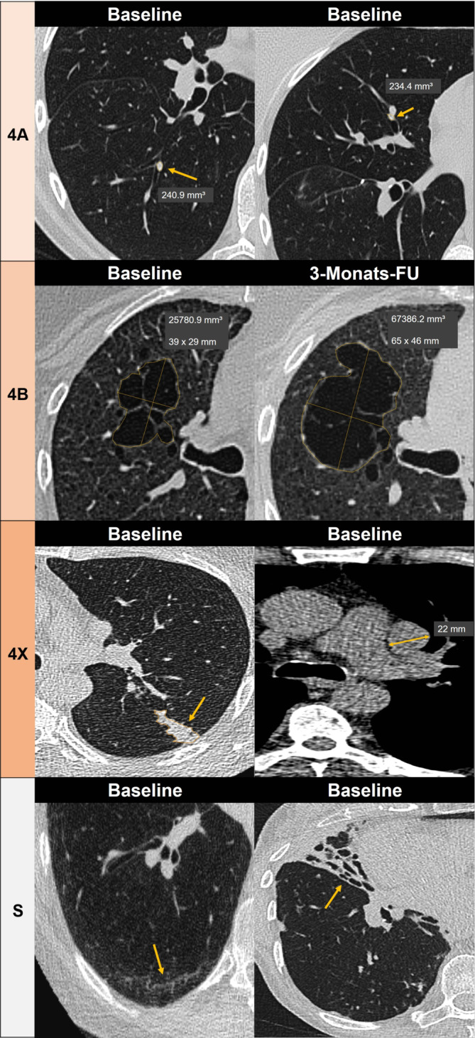 [Influence of artificial intelligence on decisions in radiology using the example of lung cancer screening].