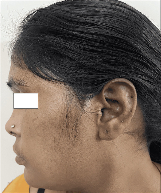 Thiamidol in Melasma in Patients of Skin of Color: A Preliminary Report of Efficacy and Safety.
