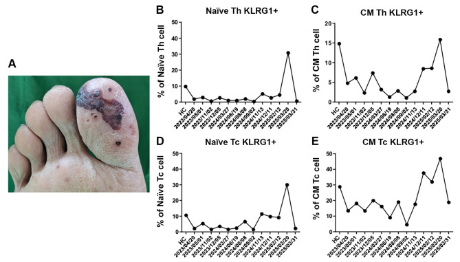 Infective Endocarditis and Valve Surgery in a Systemic Lupus Erythematosus Patient Following Splenectomy: A Case Report with Immunological Analysis.