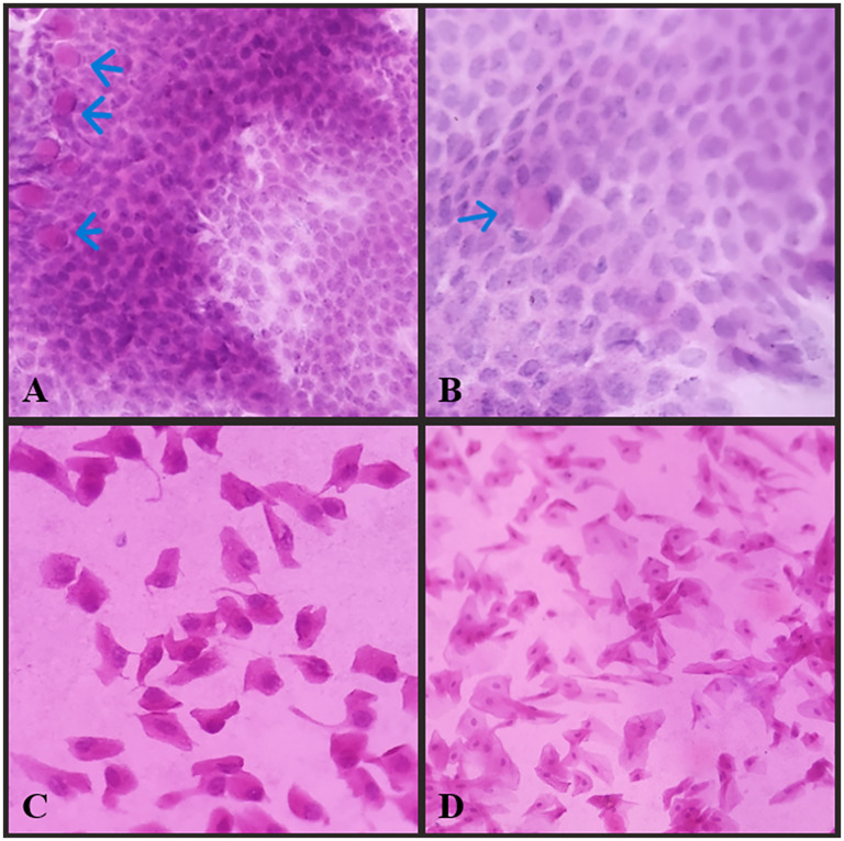 Conjunctival impression cytology and tear film analysis in early-stage Parkinson's disease.