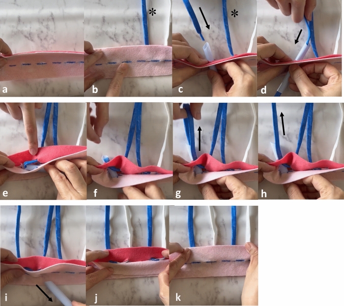 Oncoplastic breast-conserving surgery using a modified Grisotti's flap for a patient with central breast cancer in a non-ptotic breast.
