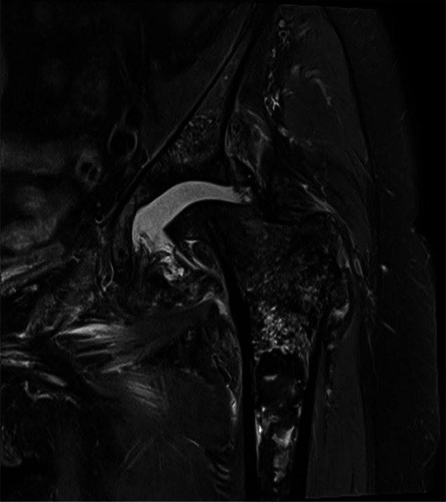 Bilateral Osteonecrosis of the Femoral Head and Proximal Femur After Corticosteroid Injections: A Case Report.
