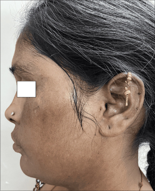 Thiamidol in Melasma in Patients of Skin of Color: A Preliminary Report of Efficacy and Safety.
