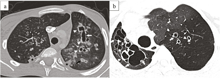 Bronchiectasis in Children: A Comparative Analysis of Cystic Fibrosis and Non-Cystic Fibrosis Etiologies Using the Bhalla Score