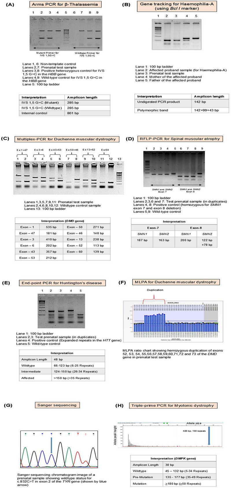 Prenatal diagnosis of rare genetic disorders: fourteen years' experience of a tertiary genetic centre from India.